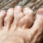 4 Easy Tips to Deal with a Painful Gout Attack